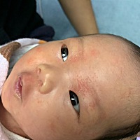 我的宝宝脸上长了跟湿疹一样的疙瘩……应该怎么做呀？大家能不能棒棒我哇？想想办法…… 快帮我