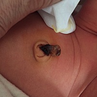新生儿宝宝出生第8天，脐带还没脱落，感觉有点凸出来，有懂这块的宝妈吗？这样正常吗？