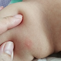 “送我上热搜”怎么发现我宝宝长这种东西？皮肤会红，里面还有一个像水泡一样但是又不知道是不是水泡的...