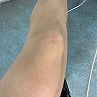 宝妈们请问怀孕初长这个红色疹子是什么情况 今天已经是第三天了。都是早晨发上了 今天已经全身到有了 关...