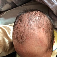 宝妈们，帮忙看看宝宝这头上长了很多小红疙瘩是湿疹还是什么啊……宝宝出生有20天了