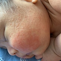 求助，谁知道宝宝脸上，身上，头上这都是什么？怎么办？热痱子？湿疹？
