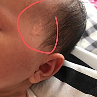 宝宝从出生脸上就有一块凸起的肉块，里面还有些白色的小米粒，这是胎记吗，还是什么，有没有同款的宝宝呀
