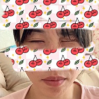 今天是我面瘫的第三天了。症状不是很严重。也不知道什么时候能好 真的很不方便 影响美观 都不好意思...
