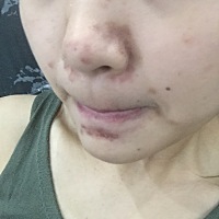 换季使用黑头贴过敏，好了后脸上有黑印。有知道用什么能淡下去的效果好一点的吗！