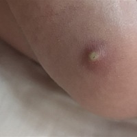 宝宝打疫苗卡介苗之后起脓包，脓流出来了，之后结痂了，但不小心被碰到了，痂掉了，请问大家怎么处理？ ...