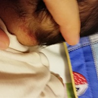 这是胎记吗，一个多月前才发现的，擦药也不见消，真担心是胎记啊😭
