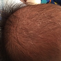 两个多月宝宝每天都洗头，头发里像起皮似的有知道是怎么回事吗？