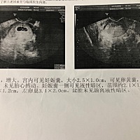 深夜记 现在也只敢晚上想想你 第一次B超很紧张生怕你不在宫内 也生怕你连卵黄囊都没有 进去之前一直恶心...