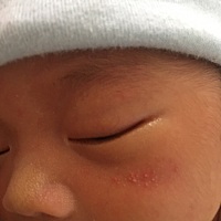 宝宝脸上长了几颗小痘痘，刚生下来有几颗，不白，现在一周了，就变白了，怎么办呀