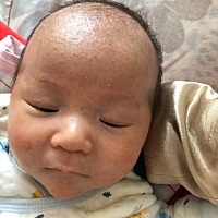 有经验的宝妈们看看我家宝宝的湿疹，昨天满月，跑到家附近的一个门诊看讲现在好多宝宝都这样，是蛋白质...