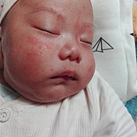 请问各位宝妈这个是湿疹吗？可以晒太阳自己慢慢好么？