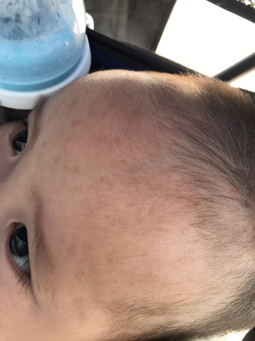 宝宝额头上长了些灰色片状的东西，热的时候变红，其他时间都是灰色，请问这是什么东西