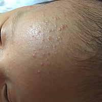 有没有宝妈有经验，因为黄疸一直拖到现在没打针，下个星期要去打满月针，有这种疹影不影响打针？应该是...