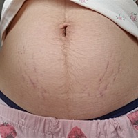 有没有妈妈们孕期身上干干净净，生完宝贝疙瘩以后没多久肚子大腿屁股上乳房上都是妊娠纹，今天照照镜子...