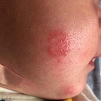 宝宝脸这一块一直不会好，是怎么回事有没有宝妈知道是什么原因，急！急！急！在线等！！！