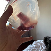 平常都是吸奶器，今天吸奶器吸出了这么多血，还有血块谁知道怎么回事吗