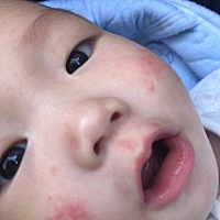 大家好、我宝宝脸上有这个、去医院看了说是奶藓、搽药好了又长反反复复、现在我都不搽药了，请问怎么才...