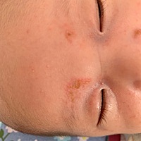 有没有宝妈知道宝宝脸上这是起的什么？求宝妈们帮忙