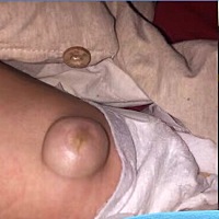 有宝妈遇见过这样子的肚脐吗？有什么好的方法可以治愈的吗？知道的宝妈麻烦告知一下，谢谢了，急……心...