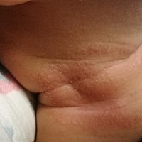 自己带娃没有经验，请问各位有经验的宝妈，宝宝脖子里的这是什么？是湿疹还是痱子？一热就发红