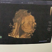 预产期当天出生好准时呀！白天开始肚子痛，晚上九点七八分钟痛一次就去医院了结果宫口没开就回家了。然...