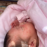宝宝不知道怎么了 脸上 脖子上都是这种痘痘 脖子上的快没了 脸上越来越多了 这是什么啊 怎么才能好 已经...