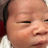 孩子脸上是湿疹还是疹还是奶藓？