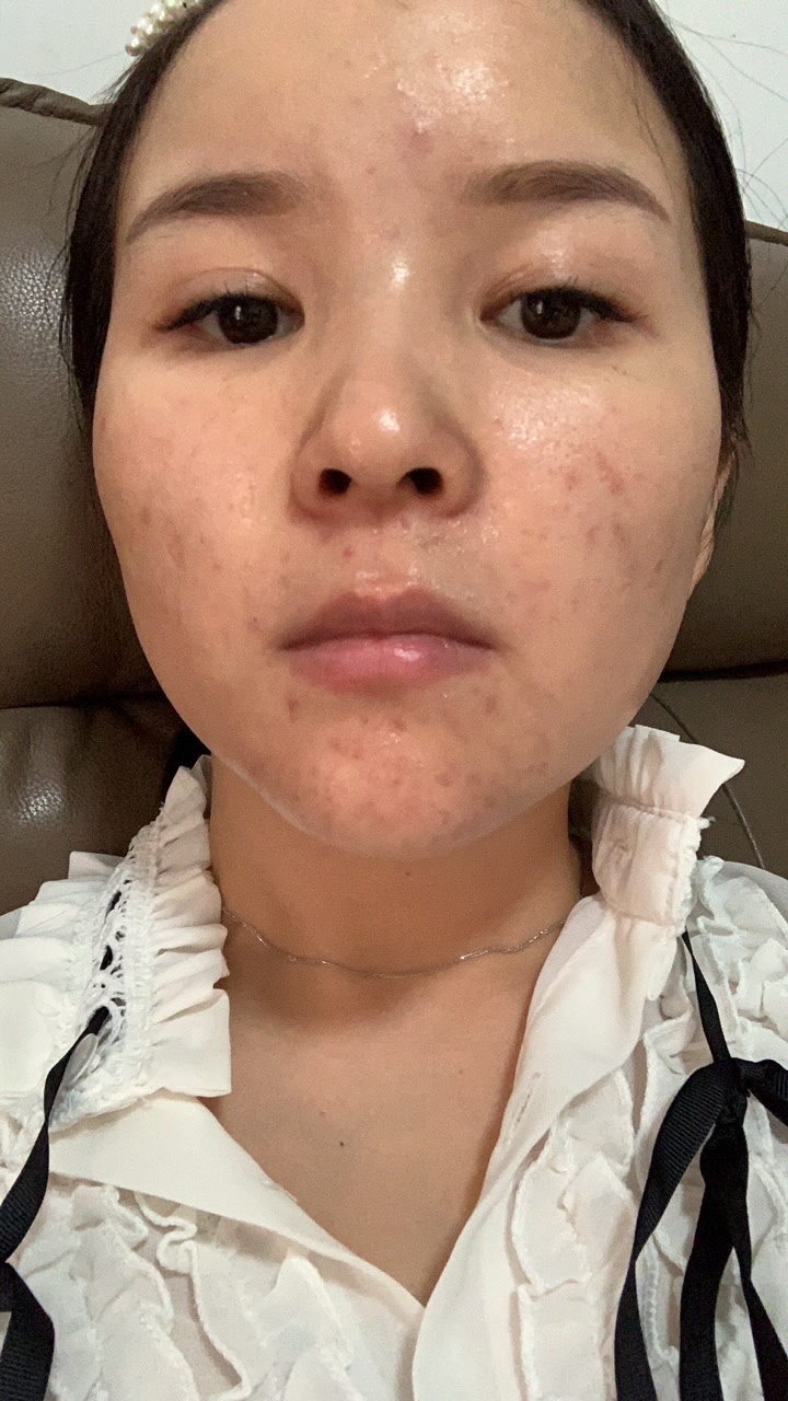 我去看过医生，也去美容院调理过，都没有用，但大部分都说我是内分泌失调导致的，前两年皮肤挺好的，这两年痘痘粉刺爆发。一波未平一波又起，求姐妹解答是什么原因。