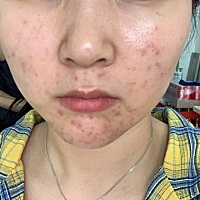 我去看过医生，也去美容院调理过，都没有用，但大部分都说我是内分泌失调导致的，前两年皮肤挺好的，这...