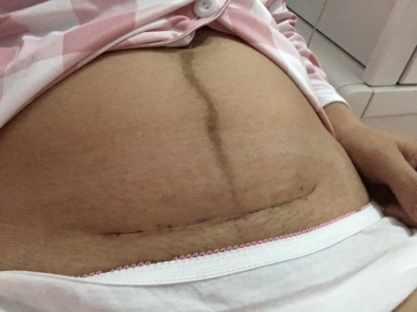 剖腹产手术后第八天的伤口，你们的恢复如何