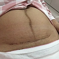 剖腹产手术后第八天的伤口，你们的恢复如何