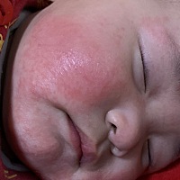 请问医生还有宝妈们     这种情况应该怎么办啊   擦诺必行婴宝 还有润肤霜都没有太大的效果  （早晚擦一...