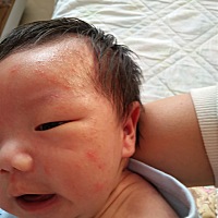 宝宝月子里脸上起了很多小疙瘩，头发里也有， 是湿疹吗？擦点什么药好一些？