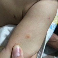 孩子不抓不挠 腿和肚子都有一点。求帮助
