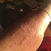 各位宝妈晚上好！我想问一下，我生了宝宝一个礼拜以后就荨麻疹了。现在宝宝在吃我母乳，荨麻疹能给宝宝...