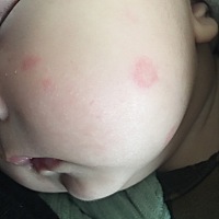 求助各位有经验的宝妈！！如图脸上身上长了很多小不一的红色斑点。没有边界。无凸起也不硬。会发烫。带...
