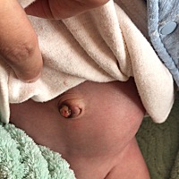 求助：宝宝早上刚掉脐带但是中间有点凸出来，平常洗澡也没沾到水，每天都有用酒精消毒的！有没有宝妈遇...
