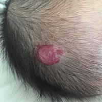 我家宝宝头上长了一个血管瘤，医生说是蔓状血管瘤，几个医生有的说时间久了会消，有的又说不会消，还说...