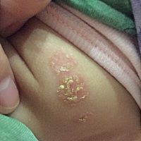 有没有同款的。是湿疹吗？涂什么能根治 看着好痒难受😣