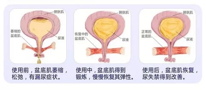 3.盆底康复训练，越早效果越好。产后一年内是盆底肌功能恢复的“黄金时黄金时间”，越早训练，效果就越好。如果不做任何训练，随着年龄增大，激素水平下降，肌肉变得松弛，症状会越来越严重。到了中老年后，很可能会出现轻中度压力性痉挛或不同程度的压力性尿失禁，有的甚至发展到子宫脱垂。