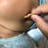 想问问大家这是胎记还是什么？