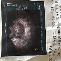 无痛人流术后7天今天去复查  彩超显示还有一点血没干净  医生开了一盒金刚藤丸和一个益母草颗粒说吃完等...