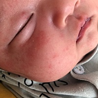 以前也有这种疹子但是不红今天突然变多了又很红，穿的很薄也没觉得热，有没有有经验的亲帮忙看看