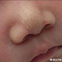 看到宝面颊和鼻子上长出了一些不红不痒的小白点，麻麻眉头一皱，又担心了。它叫新生儿粟粒疹，大约50%的...