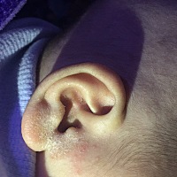 自己的不小心害得宝宝耳朵👂发炎了！宝妈们一定要注意耳朵进水了一定当时要擦干净