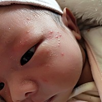 宝宝18天了，今天一早起来莫名的长了这么多痘痘。怎么回事？？？？？？？