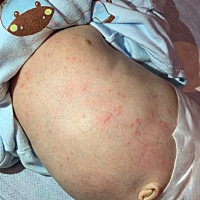 急！16天的宝宝身上突然长了好多痘痘 应该不是热的 穿的很少也没盖很多 请问怎么回事？？