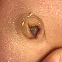 宝妈们帮忙看看我宝宝脐带掉了两天了，里边有白色的脓状物，每天也有擦碘伏，帮我看看严不严重要不要去...