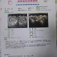 今天刚好六周，去看胎心胎芽，很给力真的有了，还买一送一，哈哈，双胎，但是另一个还没有胎心，下周再...